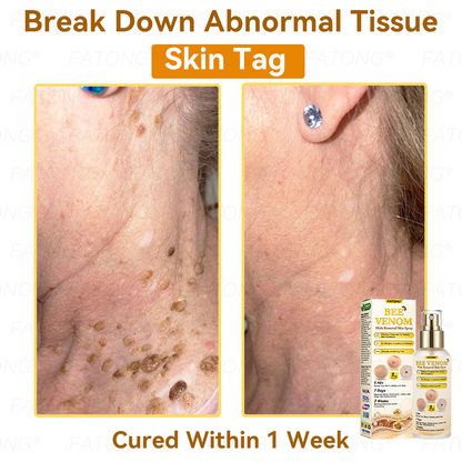 𝐹𝐴𝑇𝑂𝑁𝐺®𝐵𝑒𝑒 𝑉𝑒𝑛𝑜𝑚 𝑀𝑜𝑙𝑒 𝑅𝑒𝑚𝑜𝑣𝑎𝑙 𝑆𝑘𝑖𝑛 𝑆𝑝𝑟𝑎𝑦 –💎 𝑅𝑒𝑚𝑜𝑣𝑒 𝑀𝑜𝑙𝑒𝑠, 𝑊𝑎𝑟𝑡𝑠, 𝑆𝑘𝑖𝑛 𝑇𝑎𝑔𝑠, 𝐴𝑐𝑛𝑒 👩‍⚕️— 𝐹𝑎𝑠𝑡 & 𝑃𝑎𝑖𝑛𝑙𝑒𝑠𝑠𝑙𝑦!