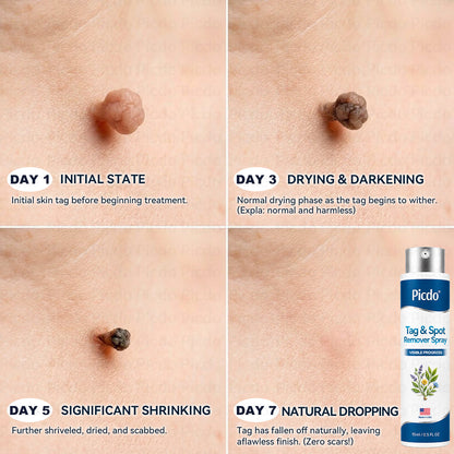 𝐏𝑖𝐜𝐝𝑜® 7-𝐷𝑎𝑦 𝑇𝑎𝑔 & 𝑆𝑝𝑜𝑡 𝑅𝑒𝑚𝑜𝑣𝑒𝑟 𝑆𝑝𝑟𝑎𝑦(Zero Pain, Zero 𝐒𝐜𝐚𝒓𝒔 Precision Spray)🚀