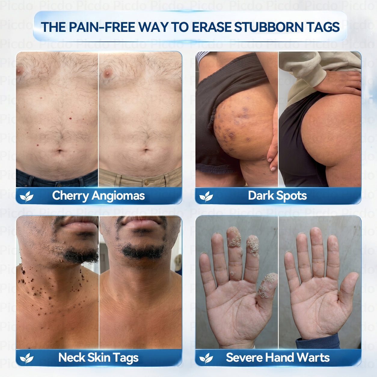 𝐏𝑖𝐜𝐝𝑜® 7-𝐷𝑎𝑦 𝑇𝑎𝑔 & 𝑆𝑝𝑜𝑡 𝑅𝑒𝑚𝑜𝑣𝑒𝑟 𝑆𝑝𝑟𝑎𝑦(Zero Pain, Zero 𝐒𝐜𝐚𝒓𝒔 Precision Spray)🚀