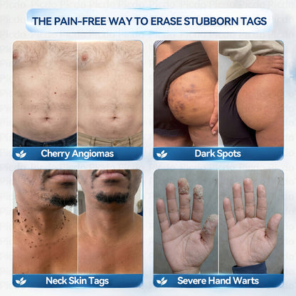 𝐏𝑖𝐜𝐝𝑜® 7-𝐷𝑎𝑦 𝑇𝑎𝑔 & 𝑆𝑝𝑜𝑡 𝑅𝑒𝑚𝑜𝑣𝑒𝑟 𝑆𝑝𝑟𝑎𝑦(Zero Pain, Zero 𝐒𝐜𝐚𝒓𝒔 Precision Spray)🚀