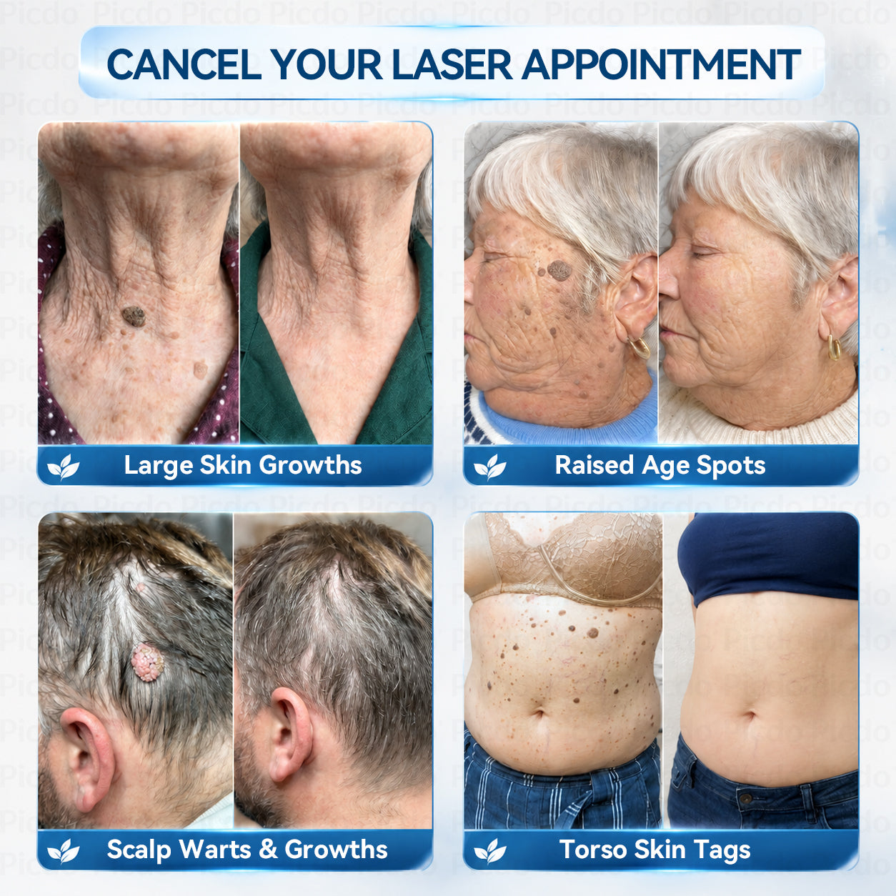 𝐏𝑖𝐜𝐝𝑜® 7-𝐷𝑎𝑦 𝑇𝑎𝑔 & 𝑆𝑝𝑜𝑡 𝑅𝑒𝑚𝑜𝑣𝑒𝑟 𝑆𝑝𝑟𝑎𝑦(Zero Pain, Zero 𝐒𝐜𝐚𝒓𝒔 Precision Spray)🚀