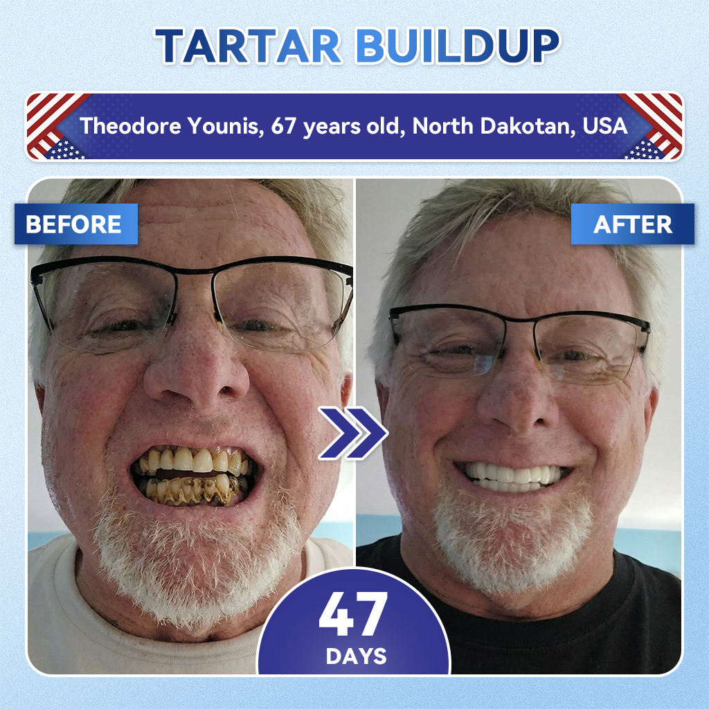 𝐆𝐥𝐢𝐦𝐦𝐞𝐫𝐥𝐲® 𝐓𝐢𝐝𝐞𝐠𝐥𝐮𝐬𝐢𝐛 𝐓𝐨𝐨𝐭𝐡 & 𝐆𝐮𝐦 𝐑𝐞𝐩𝐚𝐢𝐫 𝐌𝐢𝐜𝐫𝐨𝐧𝐞𝐞𝐝𝐥𝐞 𝐏𝐚𝐭𝐜𝐡  | 𝐀𝐝𝐯𝐚𝐧𝐜𝐞𝐝 𝐒𝐭𝐞𝐦-𝐂𝐞𝐥𝐥 𝐀𝐜𝐭𝐢𝐯𝐚𝐭𝐢𝐨𝐧 𝐓𝐞𝐞𝐭𝐡 𝐒𝐭𝐫𝐢𝐩𝐬(🦷𝐑𝐞𝐛𝐮𝐢𝐥𝐝 𝐄𝐧𝐚𝐦𝐞𝐥 & 𝐃𝐞𝐧𝐭𝐢𝐧 • 𝐒𝐭𝐫𝐞𝐧𝐠𝐭𝐡𝐞𝐧 𝐆𝐮𝐦𝐬 • 𝐄𝐫𝐚𝐝𝐢𝐜𝐚𝐭𝐞 𝐓𝐚𝐫𝐭𝐚𝐫 & 𝐎𝐝𝐨𝐫 • 𝐒𝐭𝐨𝐩 𝐓𝐨𝐨𝐭𝐡 𝐒𝐞𝐧𝐬𝐢𝐭𝐢𝐯𝐢𝐭𝐲) 🍒