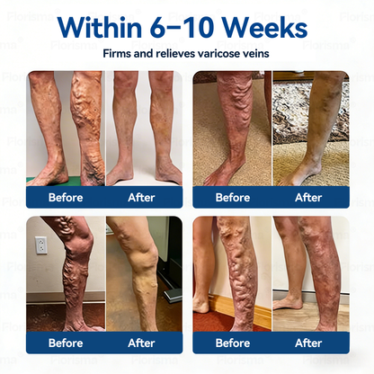 7-Day Visible Results✅𝑭𝑳𝑶𝑹𝑰𝑺𝑴𝑨® 𝐕𝐞𝐢𝐧 𝐂𝐨𝐧𝐭𝐨𝐮𝐫 𝑪𝒍𝒊𝒏𝒊𝒄𝒂𝒍-𝑮𝒓𝒂𝒅𝒆 𝑭𝒐𝒓𝒎𝒖𝒍𝒂 𝑴𝒊𝒄𝒓𝒐𝒏𝒆𝒆𝒅𝒍𝒆 𝑷𝒂𝒕𝒄𝒉(𝑫𝑰𝑶𝑺𝑴𝑰𝑵 & 𝑯𝑬𝑺𝑷𝑬𝑹𝑰𝑫𝑰𝑵)— 𝗔𝗱𝘃𝗮𝗻𝗰𝗲𝗱 𝗛𝗲𝗿𝗯𝗮𝗹 𝗕𝗹𝗲𝗻𝗱 𝗧𝗮𝗿𝗴𝗲𝘁𝘀 𝗦𝗽𝗶𝗱𝗲𝗿 𝗩𝗲𝗶𝗻𝘀 & 𝗥𝗲𝗹𝗶𝗲𝘃𝗲𝘀 𝗛𝗲𝗮𝘃𝘆, 𝗧𝗶𝗿𝗲𝗱 𝗟𝗲𝗴𝘀🚀