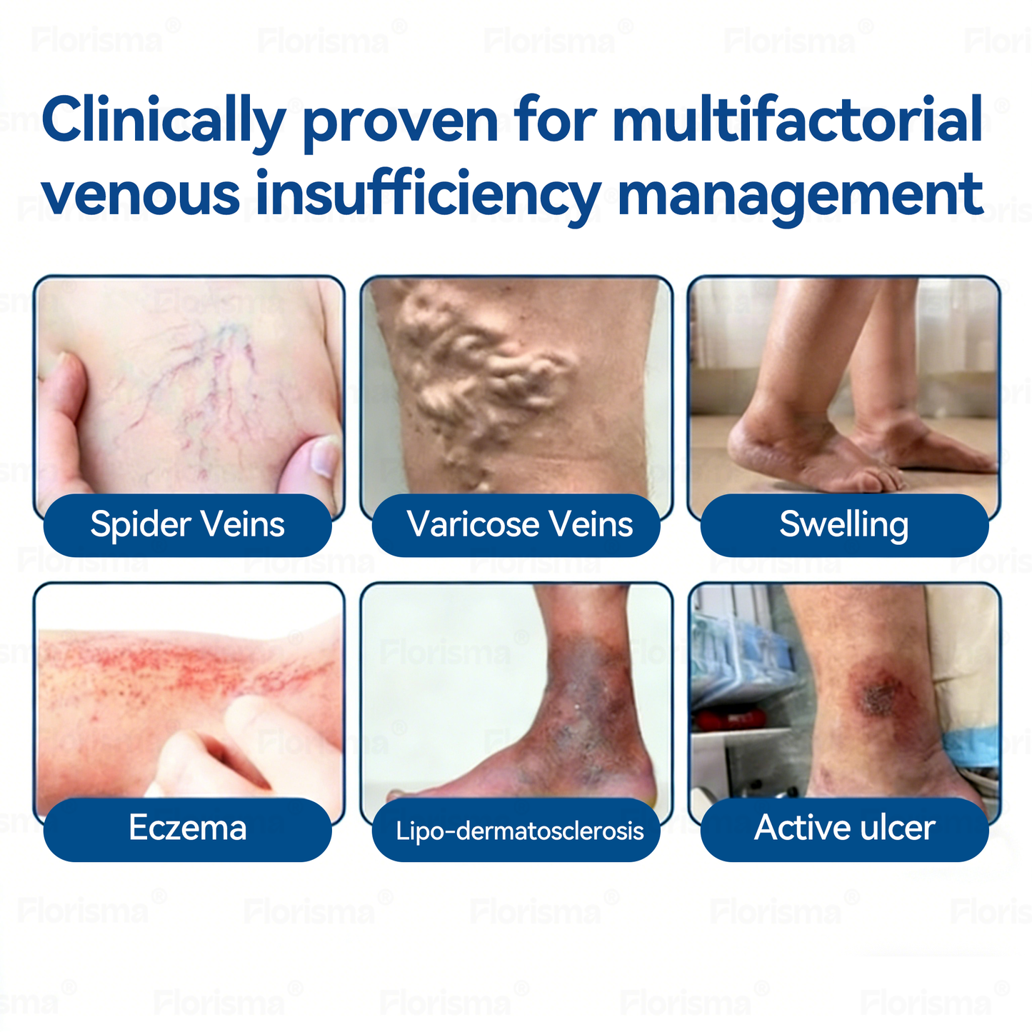 7-Day Visible Results✅𝑭𝑳𝑶𝑹𝑰𝑺𝑴𝑨® 𝐕𝐞𝐢𝐧 𝐂𝐨𝐧𝐭𝐨𝐮𝐫 𝑪𝒍𝒊𝒏𝒊𝒄𝒂𝒍-𝑮𝒓𝒂𝒅𝒆 𝑭𝒐𝒓𝒎𝒖𝒍𝒂 𝑴𝒊𝒄𝒓𝒐𝒏𝒆𝒆𝒅𝒍𝒆 𝑷𝒂𝒕𝒄𝒉(𝑫𝑰𝑶𝑺𝑴𝑰𝑵 & 𝑯𝑬𝑺𝑷𝑬𝑹𝑰𝑫𝑰𝑵)— 𝗔𝗱𝘃𝗮𝗻𝗰𝗲𝗱 𝗛𝗲𝗿𝗯𝗮𝗹 𝗕𝗹𝗲𝗻𝗱 𝗧𝗮𝗿𝗴𝗲𝘁𝘀 𝗦𝗽𝗶𝗱𝗲𝗿 𝗩𝗲𝗶𝗻𝘀 & 𝗥𝗲𝗹𝗶𝗲𝘃𝗲𝘀 𝗛𝗲𝗮𝘃𝘆, 𝗧𝗶𝗿𝗲𝗱 𝗟𝗲𝗴𝘀🚀