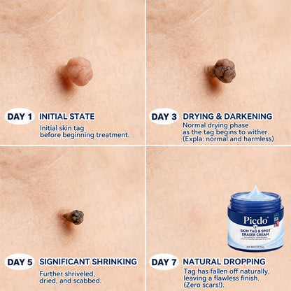 𝐏𝐢𝐜𝐝𝐨® 7-𝐃𝐚𝐲 𝐒𝐤𝐢𝐧 𝐓𝐚𝐠 & 𝐒𝐩𝐨𝐭 𝐄𝐫𝐚𝐬𝐞𝐫 𝐂𝐫𝐞𝐚𝐦🩵(Zero Pain, Zero 𝐒𝐜𝐚𝐫𝐬 Formula)🚀