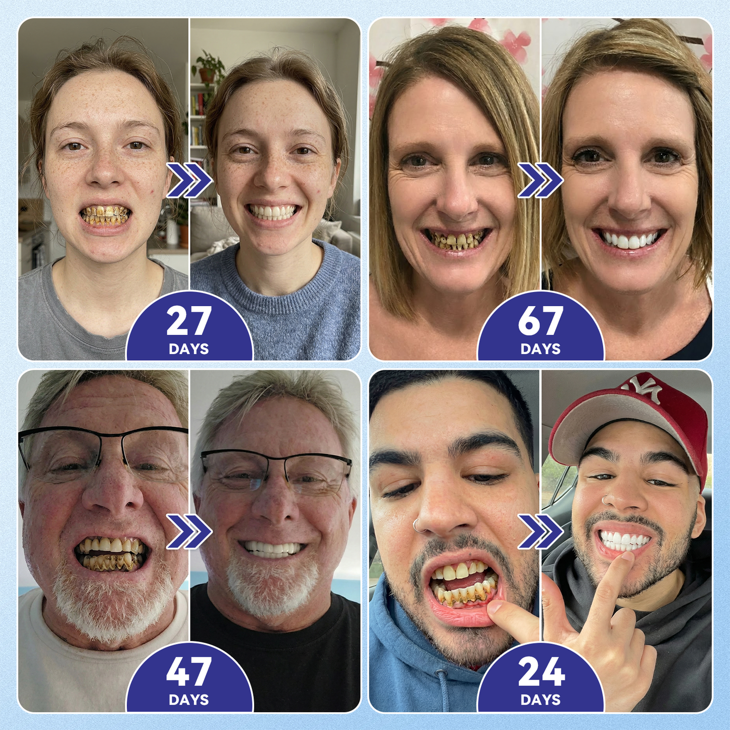 🦷𝐆𝐥𝐢𝐦𝐦𝐞𝐫𝐥𝐲® 𝐓𝐢𝐝𝐞𝐠𝐥𝐮𝐬𝐢𝐛 𝐓𝐨𝐨𝐭𝐡 & 𝐆𝐮𝐦 𝐑𝐞𝐩𝐚𝐢𝐫 𝐌𝐢𝐜𝐫𝐨𝐧𝐞𝐞𝐝𝐥𝐞 𝐏𝐚𝐭𝐜𝐡  | 𝐀𝐝𝐯𝐚𝐧𝐜𝐞𝐝 𝐒𝐭𝐞𝐦-𝐂𝐞𝐥𝐥 𝐀𝐜𝐭𝐢𝐯𝐚𝐭𝐢𝐨𝐧 𝐓𝐞𝐞𝐭𝐡 𝐒𝐭𝐫𝐢𝐩𝐬(🦷𝐑𝐞𝐛𝐮𝐢𝐥𝐝 𝐄𝐧𝐚𝐦𝐞𝐥 & 𝐃𝐞𝐧𝐭𝐢𝐧 • 𝐒𝐭𝐫𝐞𝐧𝐠𝐭𝐡𝐞𝐧 𝐆𝐮𝐦𝐬 • 𝐄𝐫𝐚𝐝𝐢𝐜𝐚𝐭𝐞 𝐓𝐚𝐫𝐭𝐚𝐫 & 𝐎𝐝𝐨𝐫 • 𝐒𝐭𝐨𝐩 𝐓𝐨𝐨𝐭𝐡 𝐒𝐞𝐧𝐬𝐢𝐭𝐢𝐯𝐢𝐭𝐲) 3.0